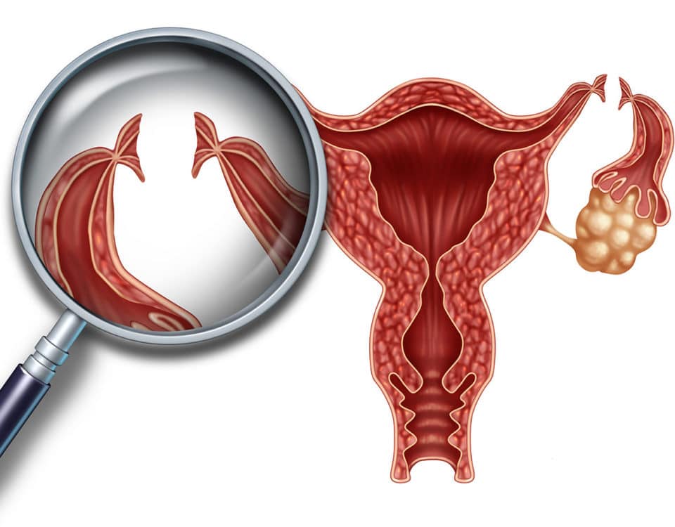 sterilisation-der-frau-um-eine-schwangerschaft-zu-verhindern